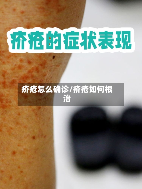 疥疮怎么确诊/疥疮如何根治-第2张图片