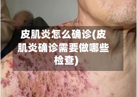 皮肌炎怎么确诊(皮肌炎确诊需要做哪些检查)-第2张图片