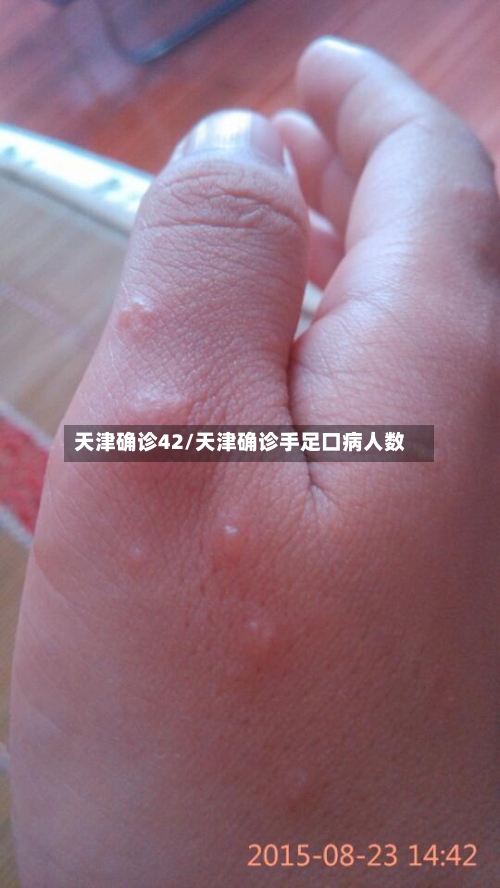 天津确诊42/天津确诊手足口病人数