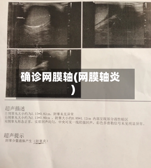 确诊网膜轴(网膜轴炎)-第2张图片