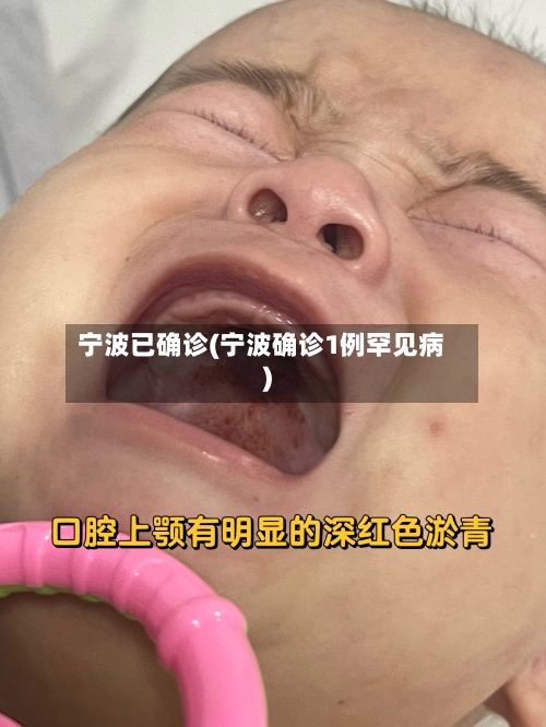 宁波已确诊(宁波确诊1例罕见病)