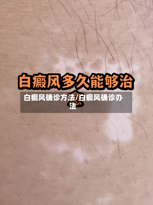 白癜风确诊方法/白癜风确诊办法-第3张图片