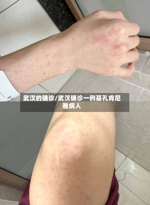 武汉的确诊/武汉确诊一例基孔肯尼雅病人-第3张图片
