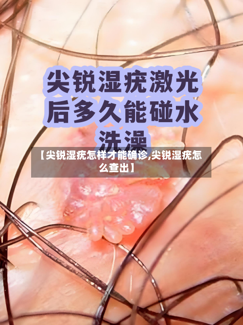 【尖锐湿疣怎样才能确诊,尖锐湿疣怎么查出】