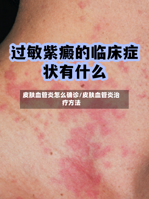 皮肤血管炎怎么确诊/皮肤血管炎治疗方法-第3张图片