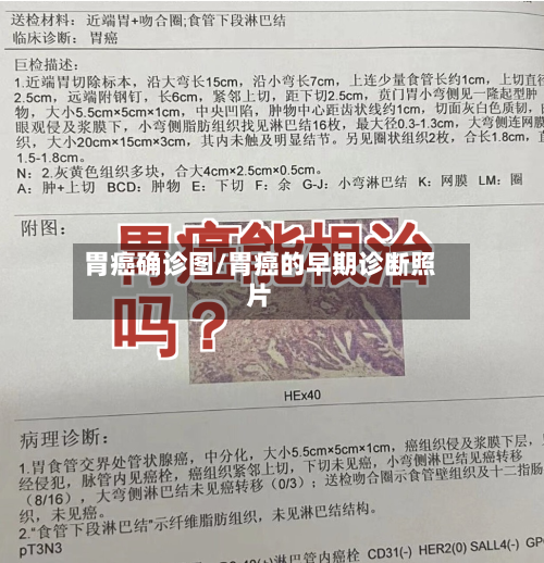 胃癌确诊图/胃癌的早期诊断照片-第3张图片