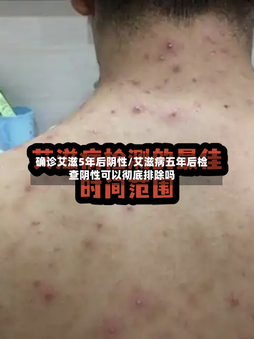 确诊艾滋5年后阴性/艾滋病五年后检查阴性可以彻底排除吗