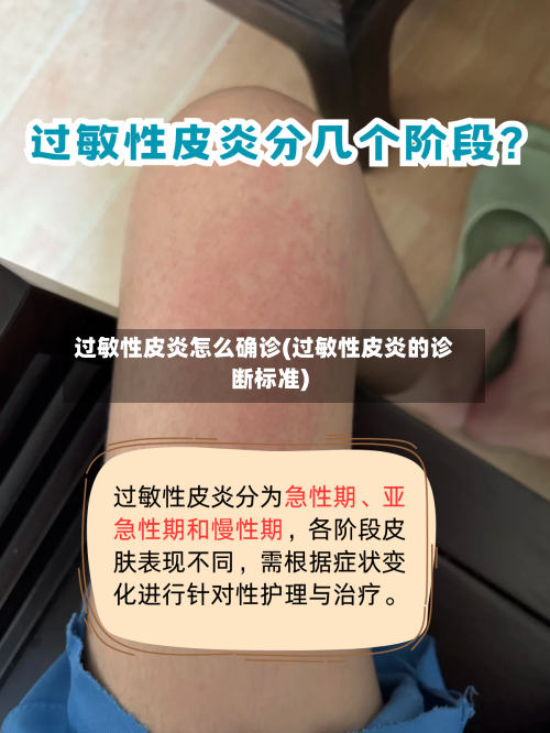 过敏性皮炎怎么确诊(过敏性皮炎的诊断标准)-第2张图片